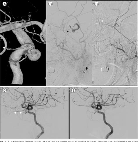 Usefulness of External Carotid Artery Angiogram with Manual Car